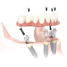 All-On-4 Implant Treatment